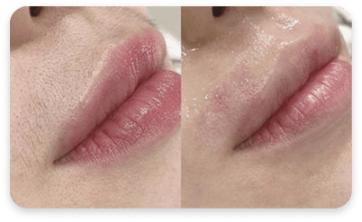 Lips Result
