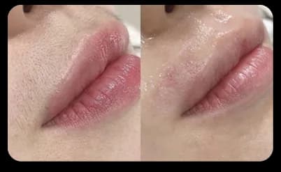 Lips Result