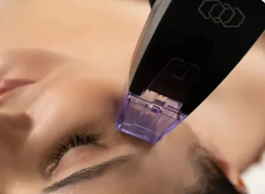 Microneedling